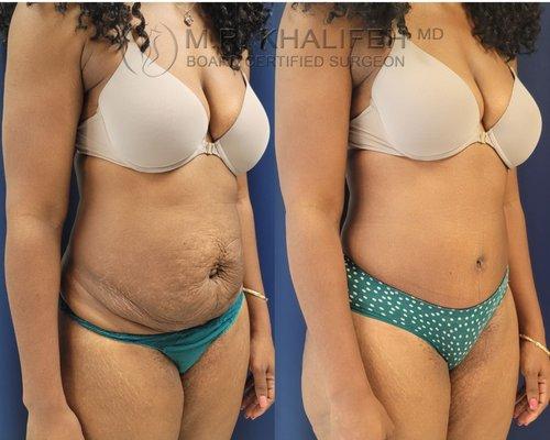 Mommy Makeover with Tummy Tuck