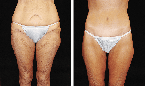 Viora Reaction RF "ReFit" body Skin Tightening