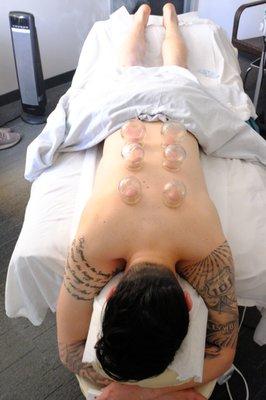 Cupping pulls fascia away and allows better circulation to affected areas.