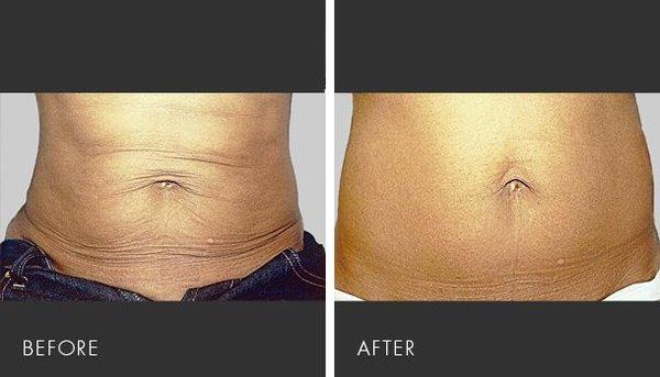 Skin Tightening, Cellulite & Fat Reduction. Non Invasive. Results visible with one treatment. Additional treatments enhance results.