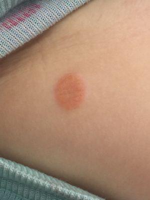 Close up of the ringworm. My other child had several spots on her back, cheek, chest...