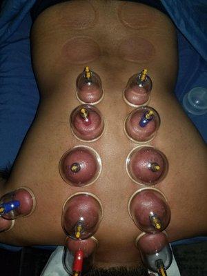 Cupping therapy for relaxation, detox, or pain management.