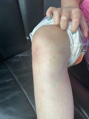 Bruise on knee that went into the hole.