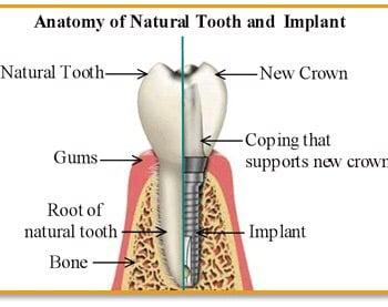 Are you ready to replace your missing teeth? Visit our dental implant infosite at www.dentalimplantsinpittsburghpa.com to learn more.