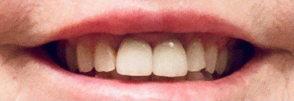 My crowns after replacement.