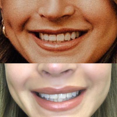 Before & After a Lip Flip procedure using Botox