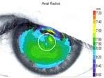 Corneal Topography