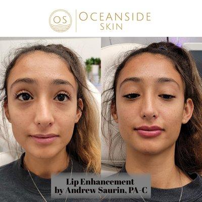 Lip enhancement