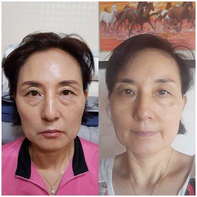 Before and after facial massage treatment