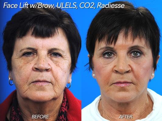 Face Lift, Brow Lift, Upper and Lower Eyelid, CO2 Laser, and Radiesse. Picture on right is seven weeks after surgery.