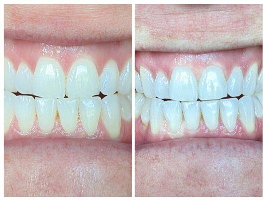 Teeth Whitening before and after a 20 minute session. Remove tears of coffee and tea stains in as little as 20 minutes. Starting at $80.00.