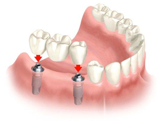 Do you have missing teeth and want something more natural? need a bridge? Implants can be placed and restored with a bridge.