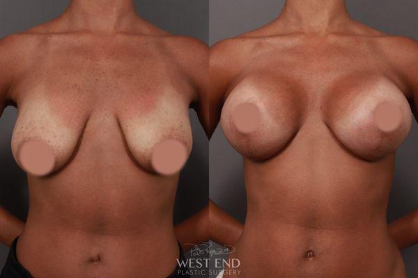 Dr. Ruff performed a Breast Lift with silicone implants.