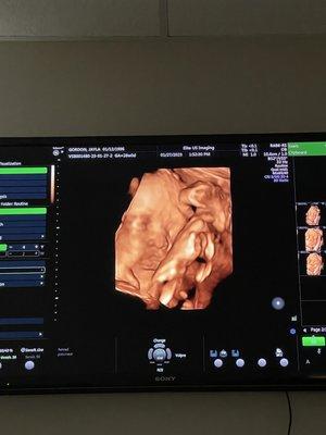 3D/4D ultrasound