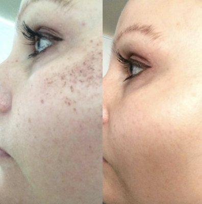 Pico Genesis Treatment results after two weeks. Pico Genesis Orange County Treatment before and after. 2 in 1 laser aesthetic procedure.