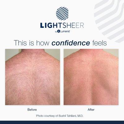 Fastest laser hair removal on market. Can do a full back in 10 minutes