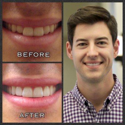 Our patient, Dustin, is very happy with his new smile.