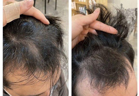 Scalp MTS needling treatment before and after hair growth