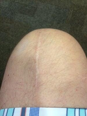 One year ago, knee was replaced!