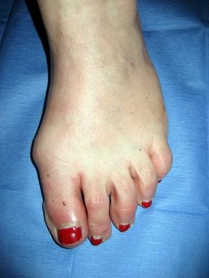 Bunion (Before Surgery)