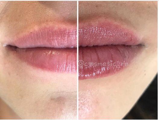 Lip Injections by Nurse Patty using Juvederm