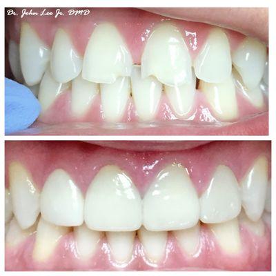 4 veneers were placed to fix this patient's chips and gaps and improve the shape of their teeth