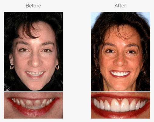 Dr. Siegel used porcelain veneers to hide her Tetracycline-stained teeth.