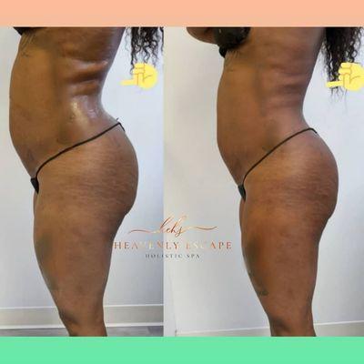 We were able to reduce the appearance of client love handles- 1 session