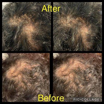 After one Plasma rich protein (PRP) hair loss treatment 2 weeks after