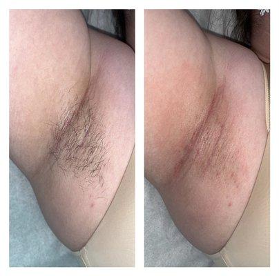 Before and after underarm wax