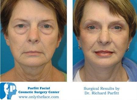 Madison WI Facial Plastic Surgery -Dr. Richard Parfitt