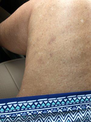 Spider veins