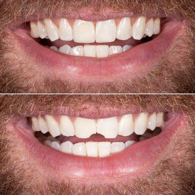 Dr. Sarno restored this patients smile with conservative bonding! No needles and no drilling!