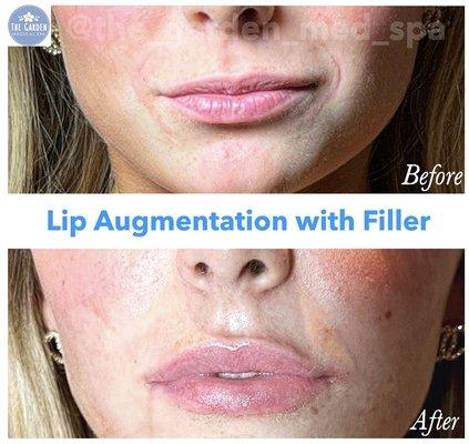 Lip Filler Results!