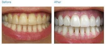 Ask us about our whitening specials!