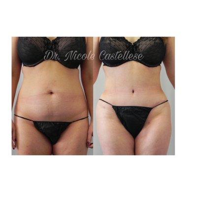 Tummy Tuck with hip and thigh Liposuction