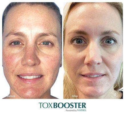 Medical grade chemical peels can be done with botox.