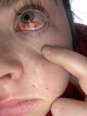 Eye infection