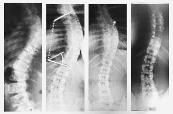 Just in case you need a visual! #Scoliosis #Miracle #ThankYouJesus.