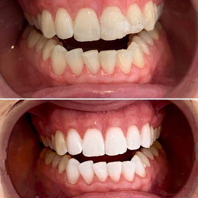 Before & After Professional Teeth Whitening!