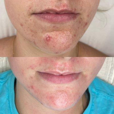 Acne Bootcamp Results