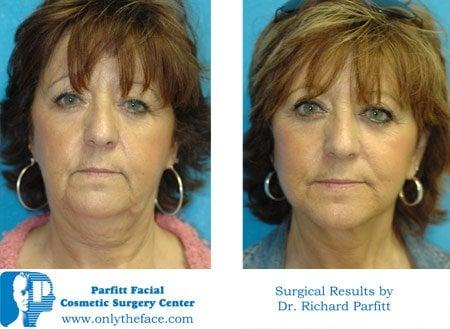 Neck and Face Lift Plastic Surgery WI -Dr. Richard Parfitt