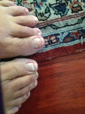 My mother's nails after getting a pedicure. Fungus galore!!!!