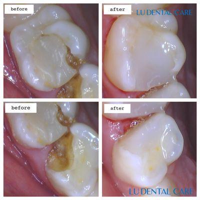 Happy Thursday! natural white fillings to restore lockdown cavities on 10 year old male.