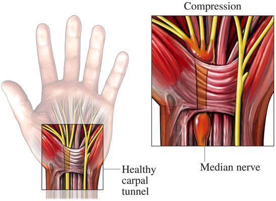 Problemas de Tunel Carpal.