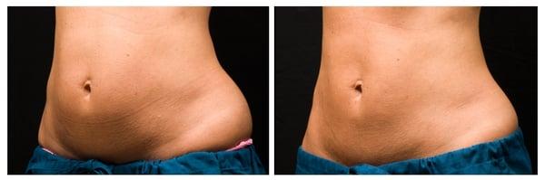 Before and after 2 months after one CoolSculpting procedure.