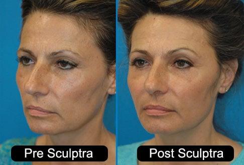 Sculptra Madison WI