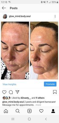 Pigmentation treatment after chemical peels