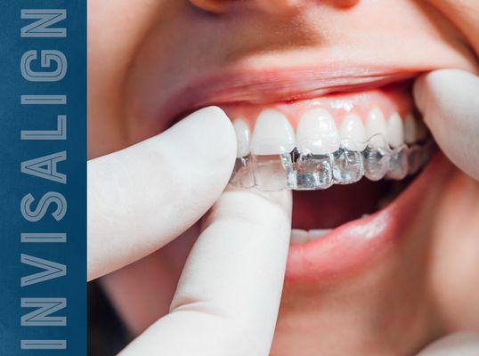 We provide Invisalign orthodontics to straighten teeth without traditional braces