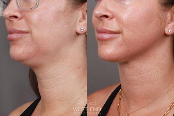 Dr. Ruff performed Liposuction of the Submental, Jawline, and Neck Region. The patient is 5 months post-Op.